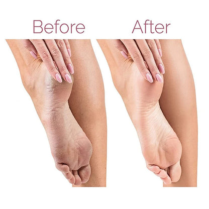مبرد القدم الكهربائي لإزالة الجلد الخشن | Electric Pedicure Foot File Callus Remover